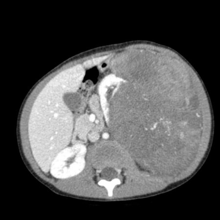 компьютерная томография почек