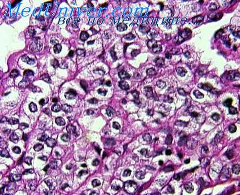 нефробластома
