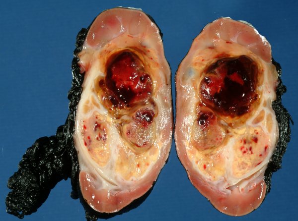 биопсия с формированием столбика ткани