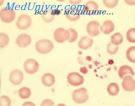 двс-синдром новорожденных