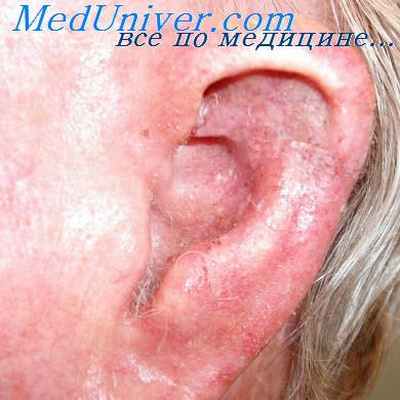 некротический лабиринтит