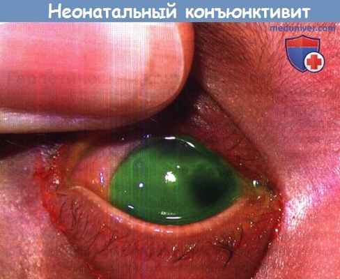 Неонатальный конъюнктивит