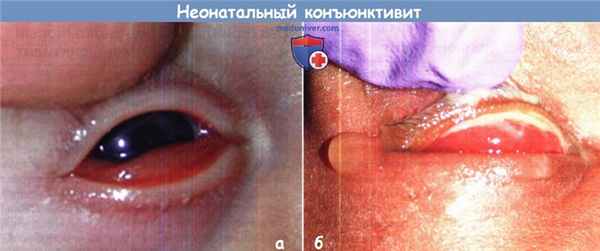 Конъюнктивит у новорожденного (неонатальный конъюнктивит)