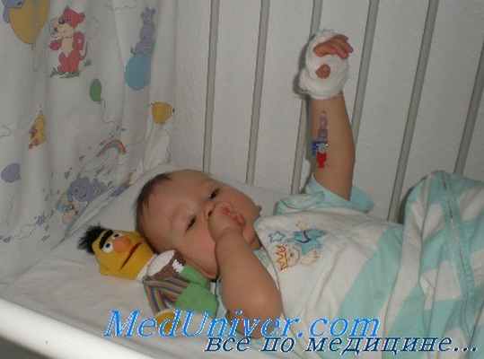 неонатальные судороги