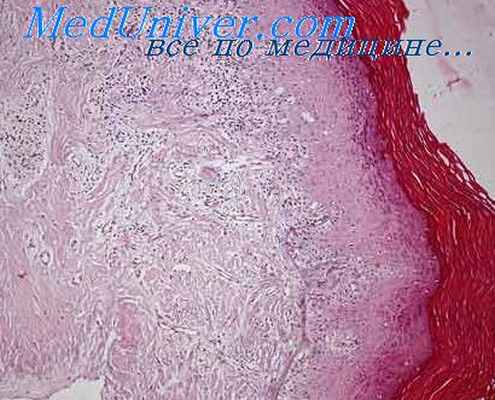 неоплазия вульвы