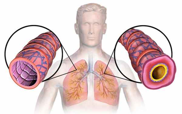 Приступ бронхиальной астмы: неотложная помощь, алгоритм действий и рекомендации врачей