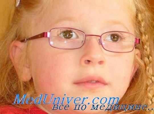 ложное косоглазие