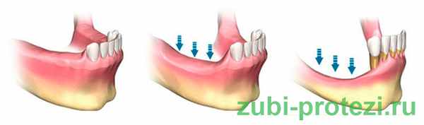 атрофия кости