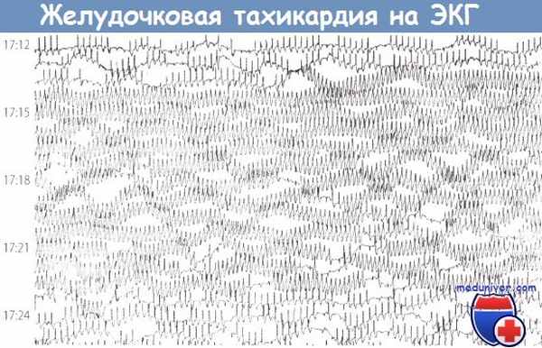 Желудочковая тахикардия на ЭКГ