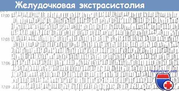 Желудочковая экстрасистолия на ЭКГ