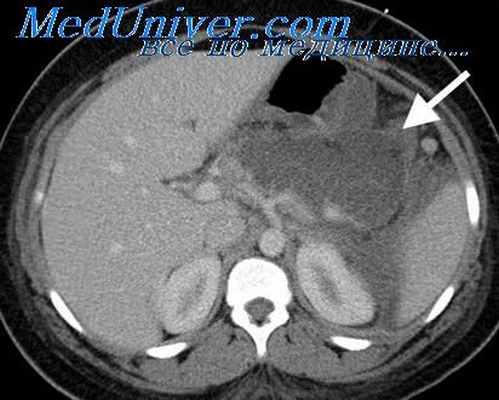 кишечная непроходимость
