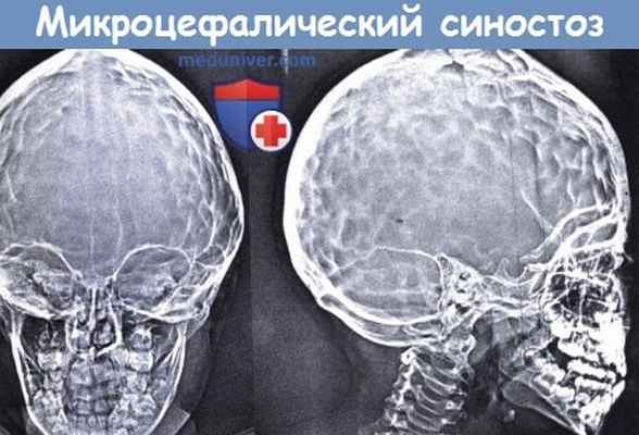 Микроцефалический синостоз