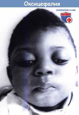 Оксицефалия
