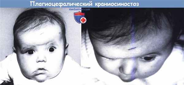 Плагиоцефалический краниосиностоз - венечный краниосиностоз