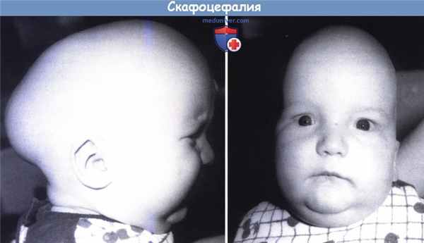 Скафоцефалия - саггитальный краниосиностоз