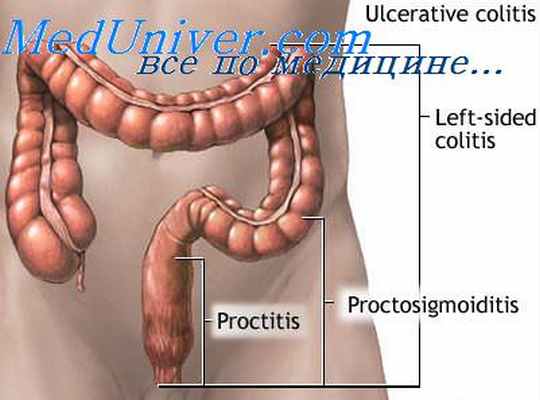 язвенный колит