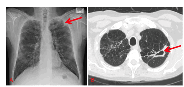Нетуберкулезные микобактериальные инфекции: диагностика и терапия, фото 1
