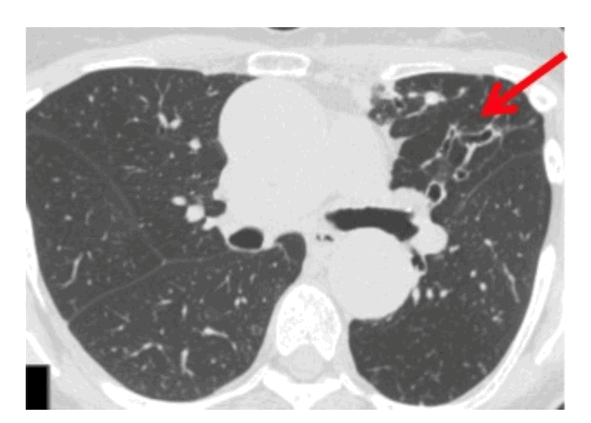 Нетуберкулезные микобактериальные инфекции: диагностика и терапия, фото 2