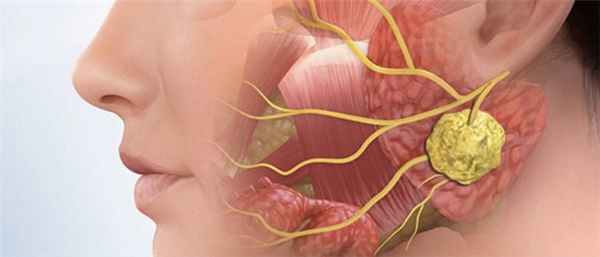 Невралгия тройничного нерва