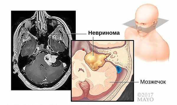 МРТ невриномы слухового нерва
