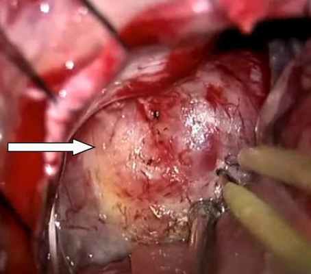 Интраоперационная фотография. Макроскопический вид невриномы слухового нерва (белая стрелка)