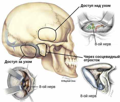 Варианты доступа к невриноме