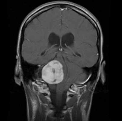 Невринома слухового нерва