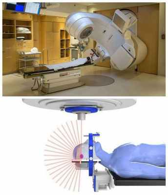 Радиотерапия невриномы