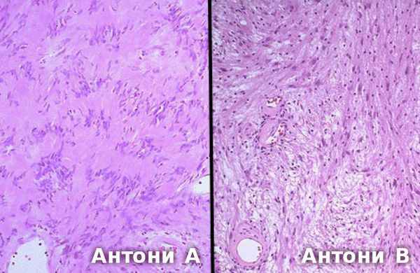 Гистологический препарат: слева тип Антони А, справа тип Антони В