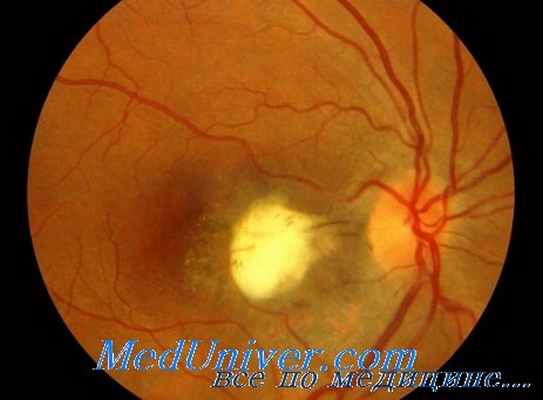нейроретинит при токсокарозе