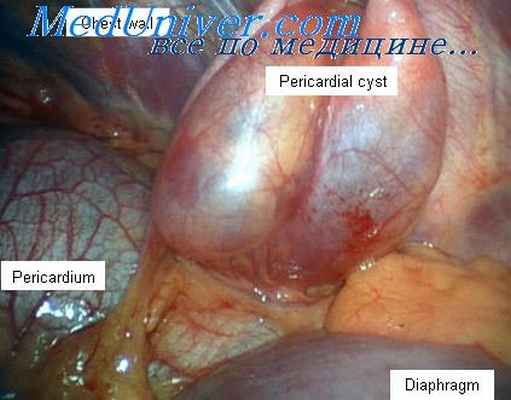 опухоли средостения