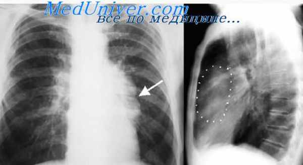опухоли средостения