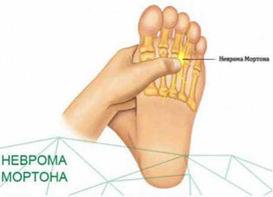 nevroma-mortona-1.jpg