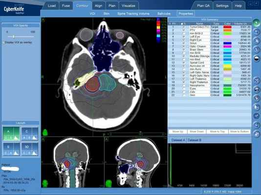 Акустическая неврома (невринома слухового нерва): план радиохирургического лечения на КиберНоже