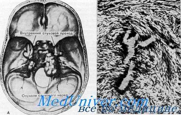 невромы слухового нерва