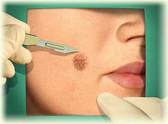 Родинки – стоит ли их удалять