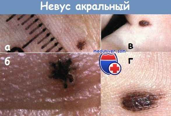 Невус акральный
