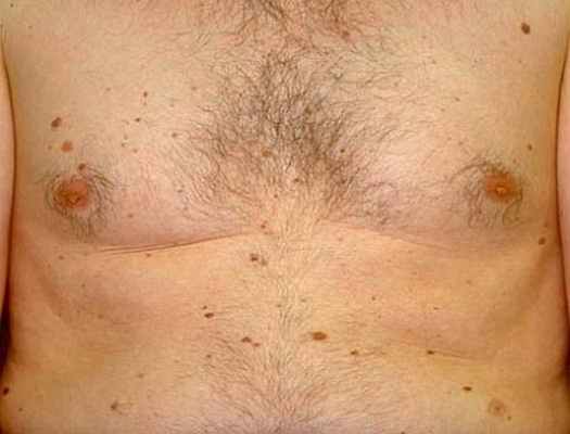 Внутридермальный невус или родинка. Невус из баллонообразных клеток