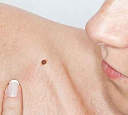 Несет ли родинка угрозу?