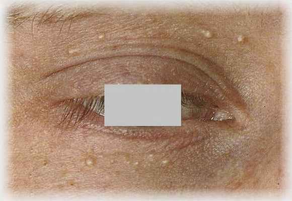 невус глаза