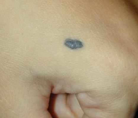 синий невус