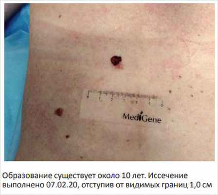 Рисунок 4. Меланома in situ на фоне диспластического невуса у женщины 35 лет