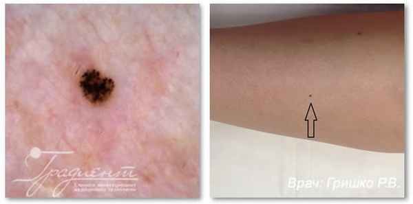 Ранняя стадия развития злокачественной меланомы кожи, врач: Гришко Роман Васильевич