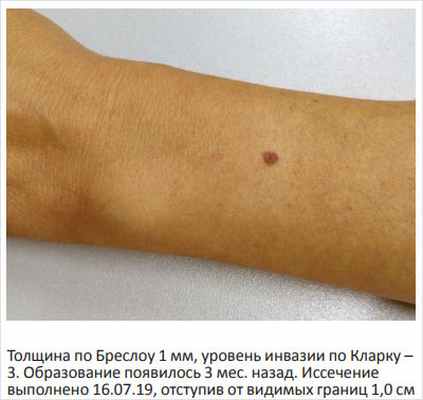 Рисунок 7. Поверхностно-распространяющаяся меланома левого предплечья 0,4 см в диаметре у женщины 52 лет