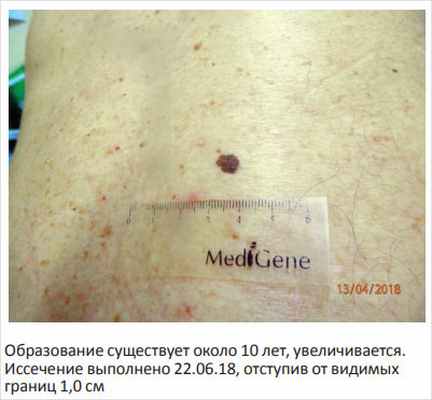 Рисунок 3. Лентигинозный невус поясничной области у мужчины 77 лет, с очаговой лентигинозной меланоцитарной дисплазией 3-й ст.