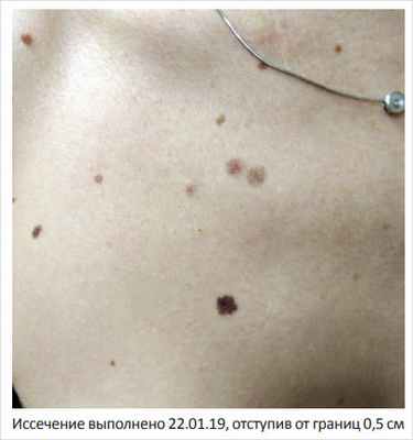 Рисунок 1. Диспластический невус грудной стенки у женщины 45 лет с лентигинозной меланоцитарной дисплазией 2-й ст.