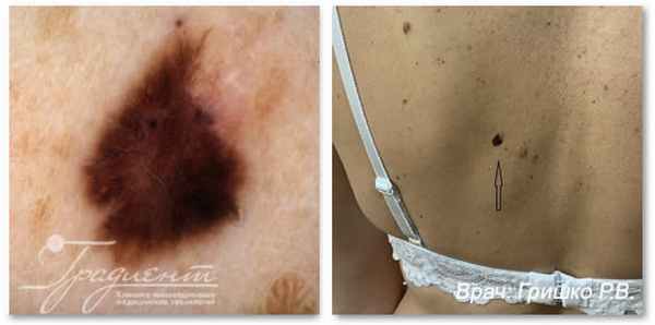 Поверхностная атипичная пролиферация меланоцитов (SAMPUS) на фоне малого врожденного меланоцитарного невуса с признаками регресса, врач: Гришко Роман Васильевич
