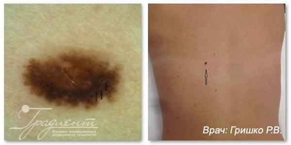 Невоидная злокачественная меланома кожи в фазе горизонтального роста, врач: Гришко Роман Васильевич