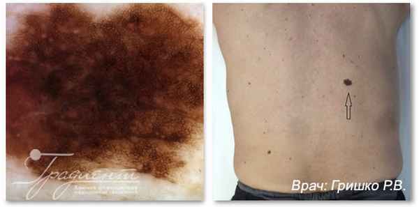 Невоидная меланома кожи в фазе горизонтального роста:, врач: Гришко Роман Васильевич