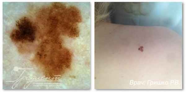 Поверхностно-распространяющаяся меланома кожи в фазе горизонтального роста без изъязвления, с признаками регресса, врач: Гришко Роман Васильевич